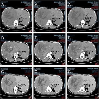 Mixed Neuroendocrine Carcinoma and Hepatocellular Carcinoma: A Case Report and Literature Review